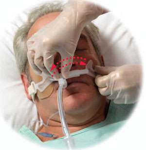 Adjusting the Anchor Fast Oral Endotracheal Tube Fastener