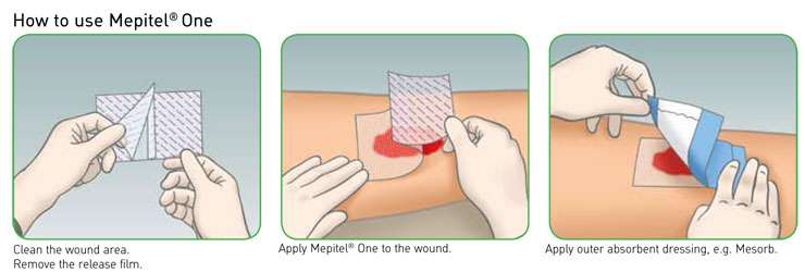 Mepitel One Wound Dressing