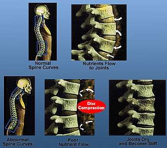 Posture Pro Posure Pumps Spine Treatment