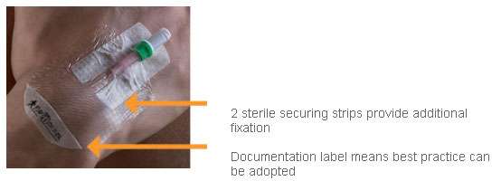 Opsite IV 3000 Transparent Dressing