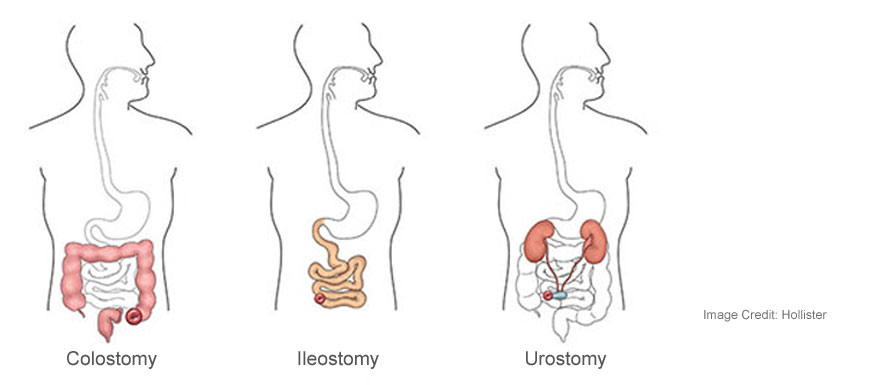 Types of Ostomies