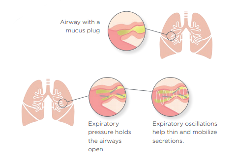 OPEP Dislodges Lung Mucus