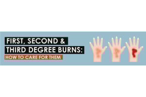 First, Second, and Third Degree Burns: How to Care for Them
