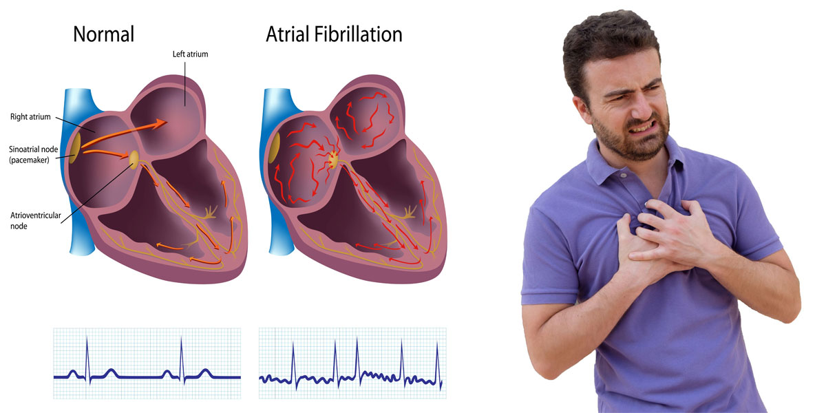 Cardiac Arrhythmias