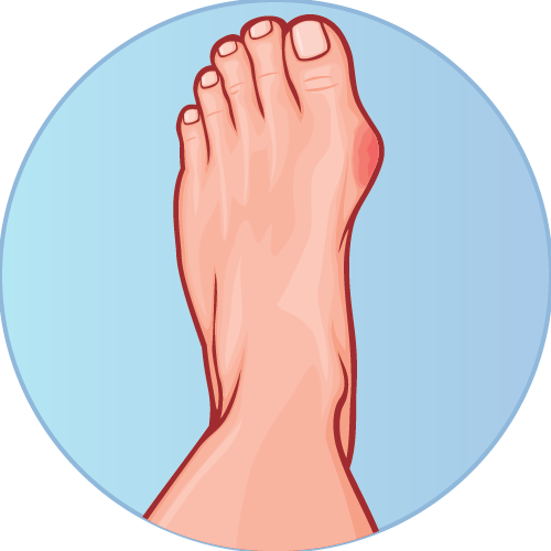 Shop Bunion Relief 
