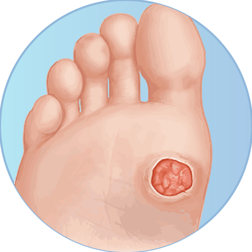 Shop Diabetic Ulcers/Wounds