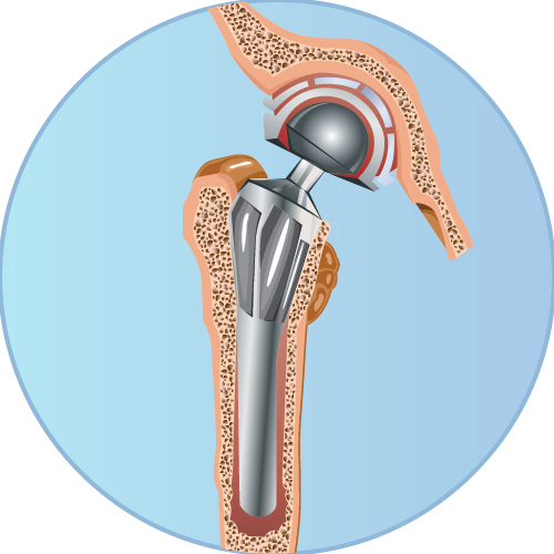 Hip Replacement/Surgery