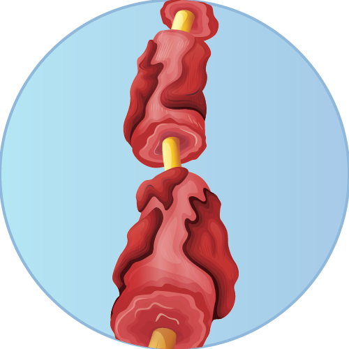 Multiple Sclerosis