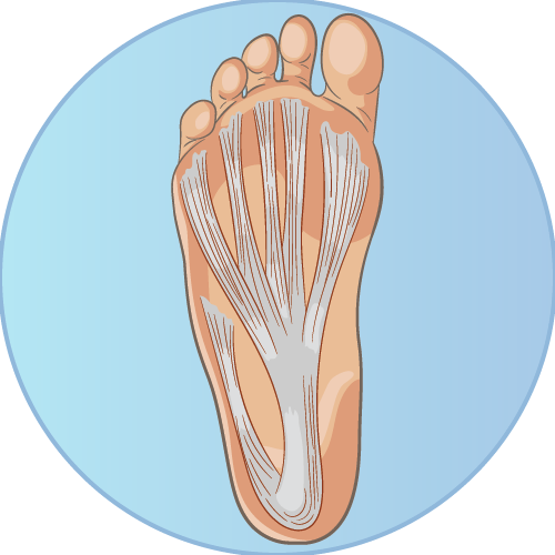 Plantar Fasciitis