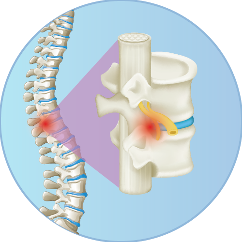 Spinal Cord Injury