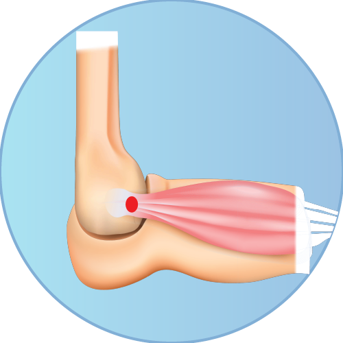 Shop Tennis Elbow