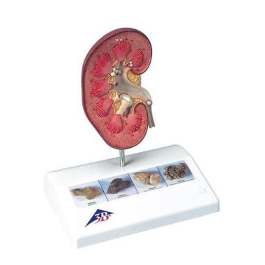 3B Scientific Kidney Stone Model