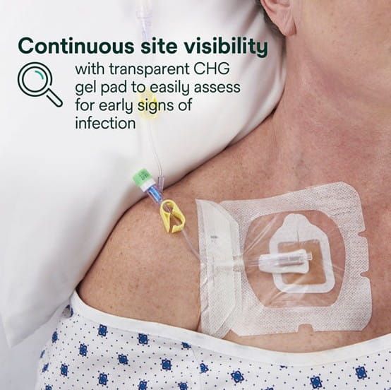 Continuous Site Visibility With Transparent CHG Gel Pad to Easily Assess for Early Signs of Infection