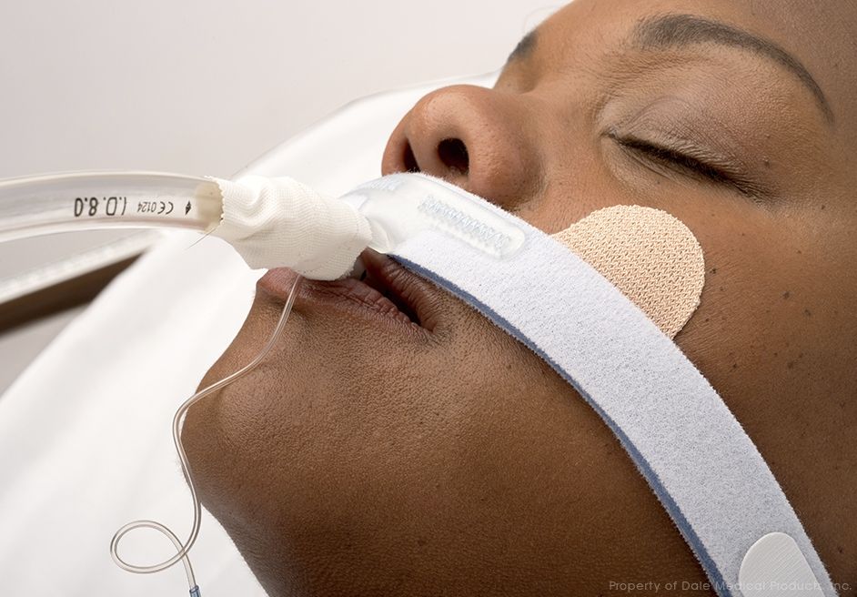 Stabilock Fits endotracheal tube sizes 7.0-10.0mm