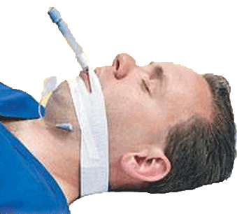 TrachTape Endotracheal Tube Securing Adhesive Tape