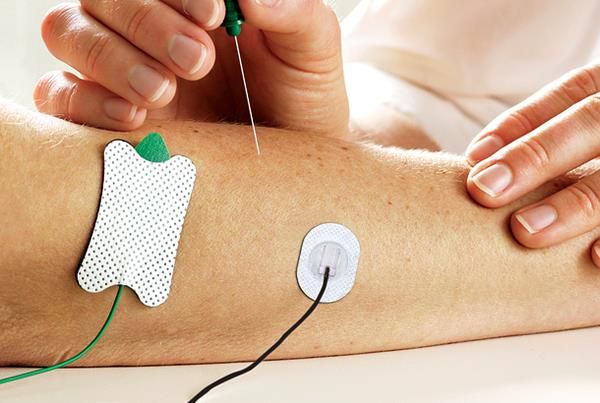 Image 3 of Ambu Neuroline Surface Electrode 715 - Silver/Silver Chloride Sensor