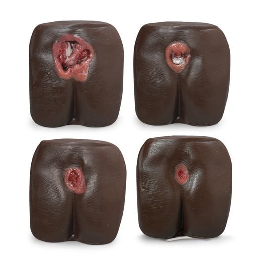 Image 2 of Life/Form Pressure Ulcer/Bedsore Models