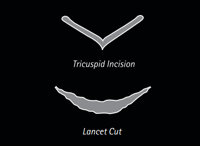 Lancet Cut