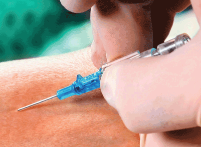 IV Catheter Application
