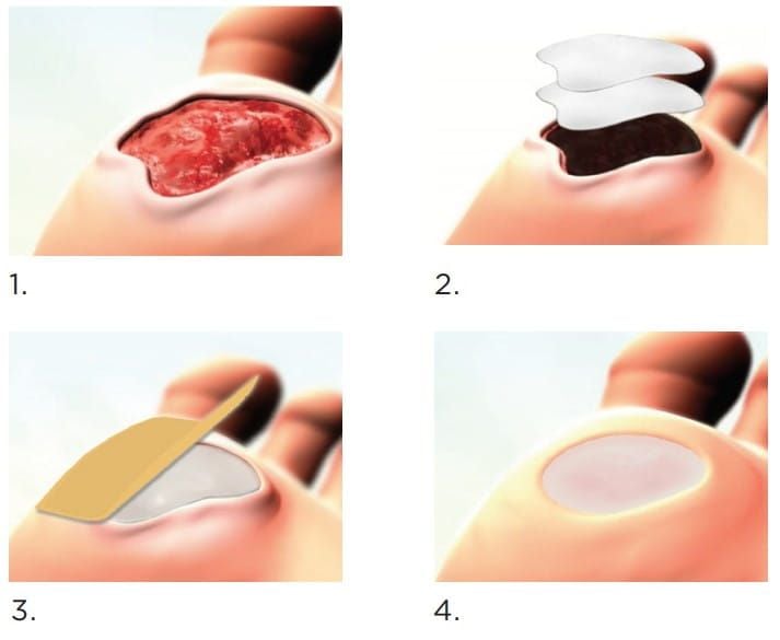 How to apply dressing