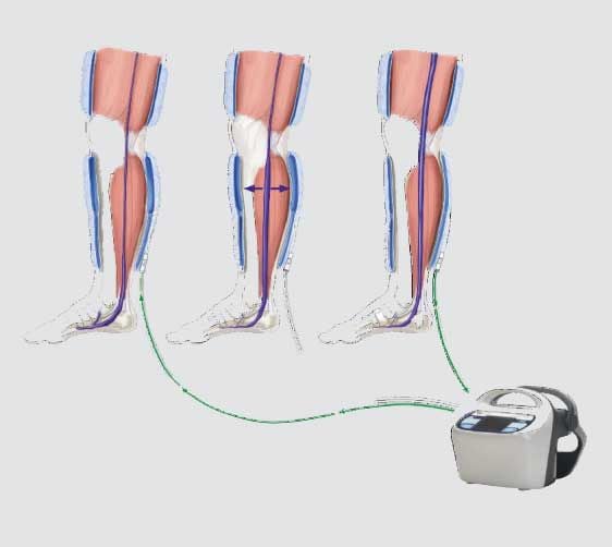 DVT Compression Therapy