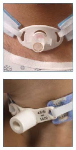 Dale Tracheostomy Tube Holder Collars