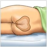 Image 3 of Eclypse Adherent Sacral Super Absorbent Dressing CR3986 | 8-7/10 x 9 Inch