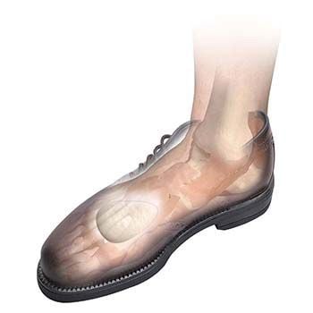 Image 3 of Hapad Metatarsal Pads & Longitudinal-Metatarsal Arch Pads