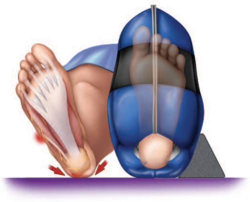 Preserves the Peroneal Nerve