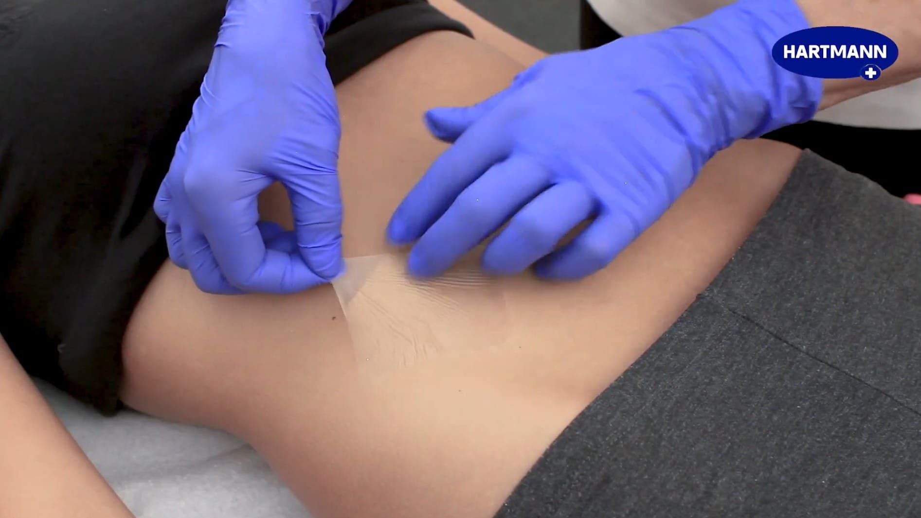Removing Hydrofilm from abdomen