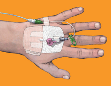 OpSite IV3000 1-Hand IV Dressing Application