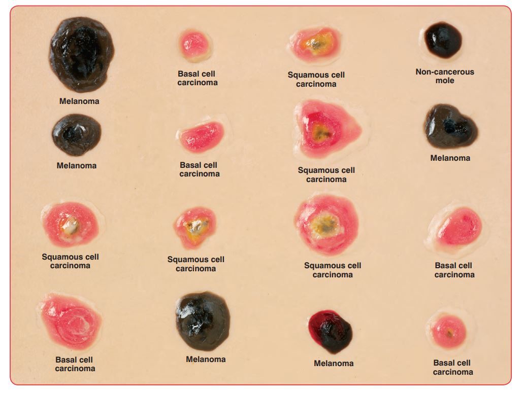 Image 3 of Life/form Skin Cancer Trainer - Enlarged