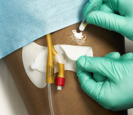 Mastisol Medical Adhesive Application