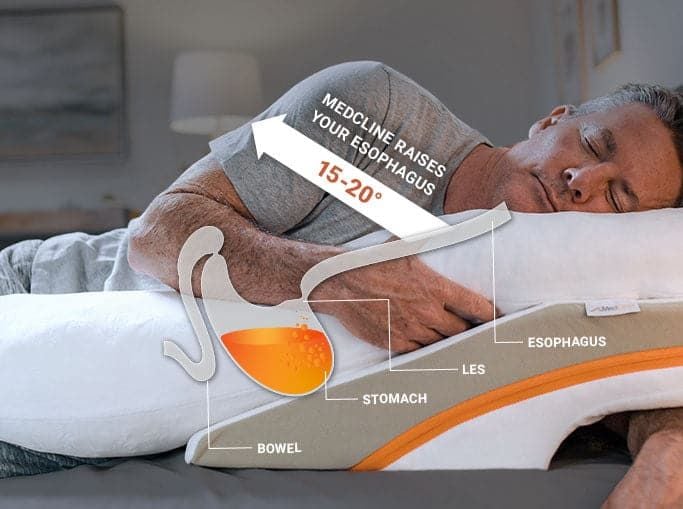 MedCline Reflux System Raises Esophagus for GERD Relief