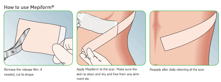 Mepiform Silicone Dressing