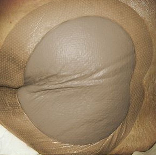 Mepilex Border Ag Sacrum Application