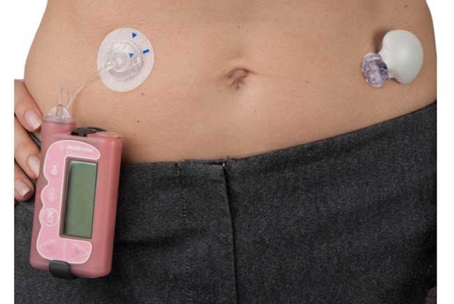 Placement with insulin pump - female