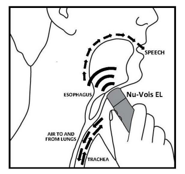 Electo-Larynx Digital Speech Aid