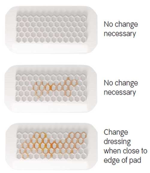 OpSite Post-Op Visible Absorbent Transparent Dressing Changing