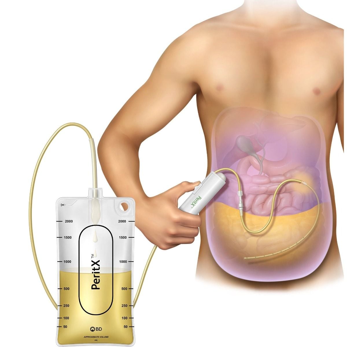 PeritX 2L Drainage Kit - Catheter System in use graphic
