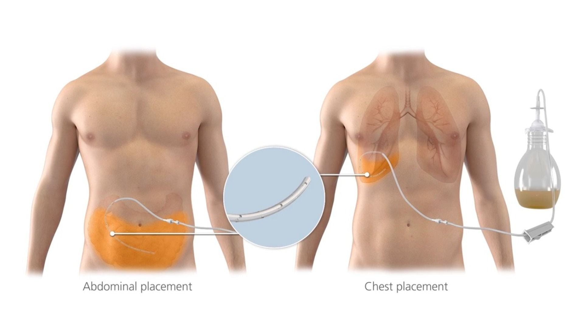 Abdominal placement and chest placement