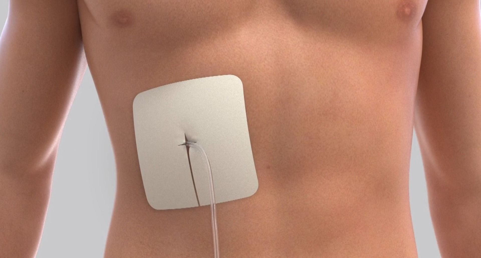 PleurX Drainage tube inserted into a patient