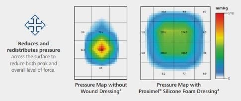 Reduces and redistributes pressure