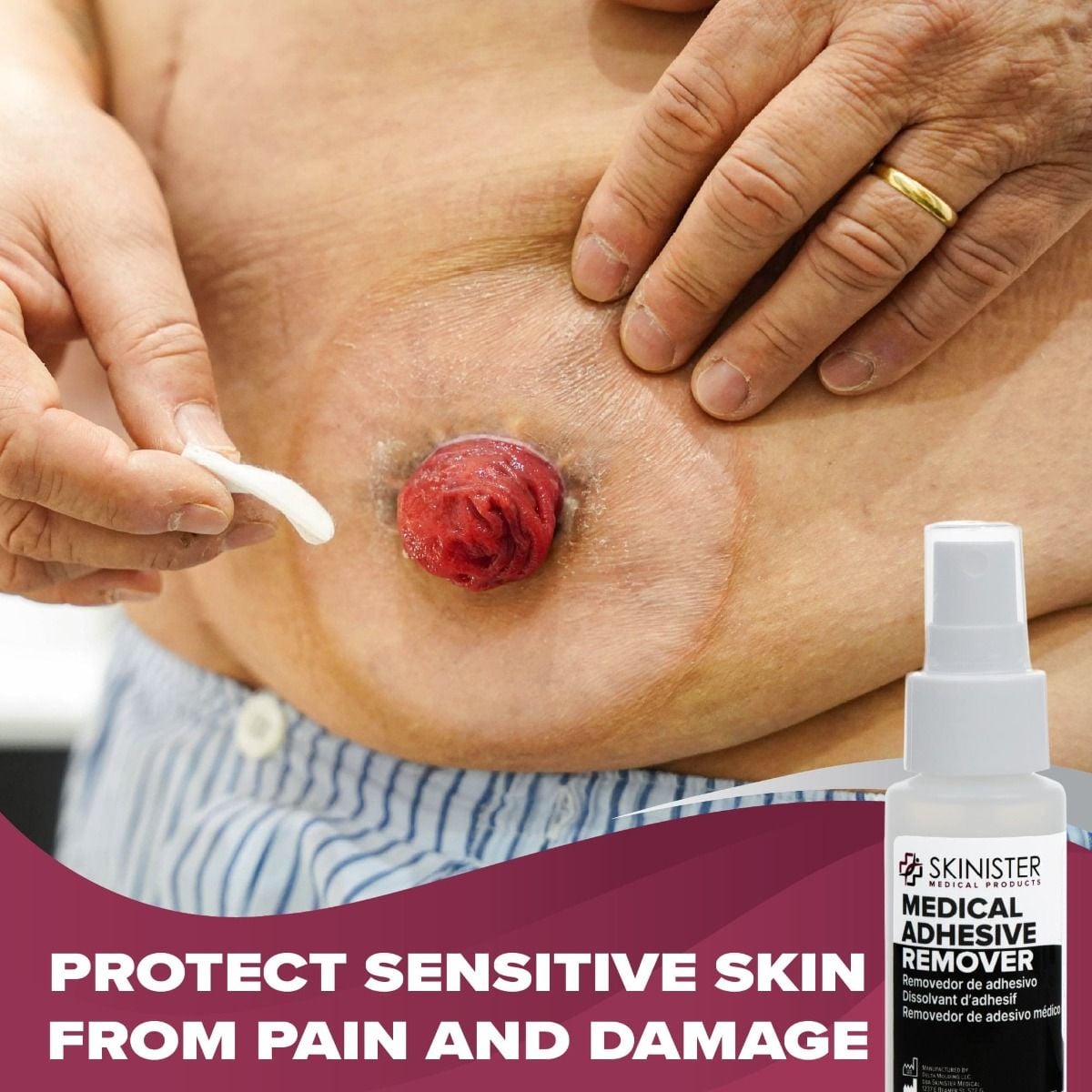 Protect Sensitive Skin From Pain and Damage