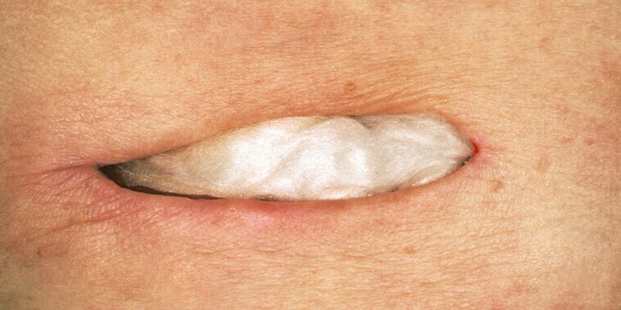 Image 4 of Sorbalgon Alginate Dressing