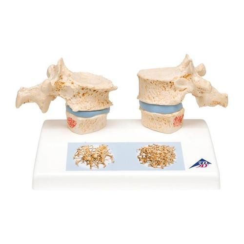 Image 1 of 3B Scientific Osteoporosis Model