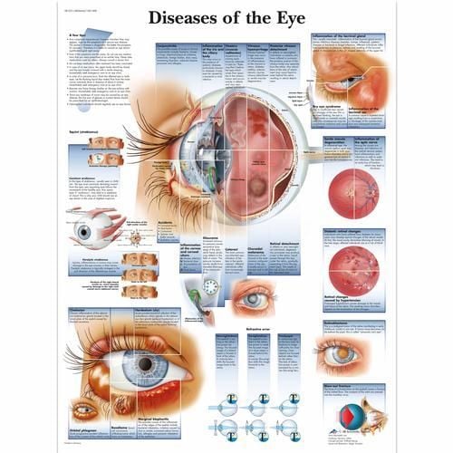 Image 1 of 3B Scientific Diseases of the Eye Chart