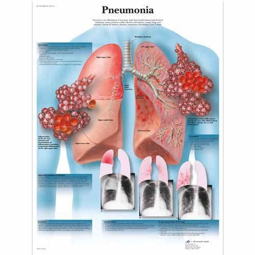 Image 1 of 3B Scientific Pneumonia Chart