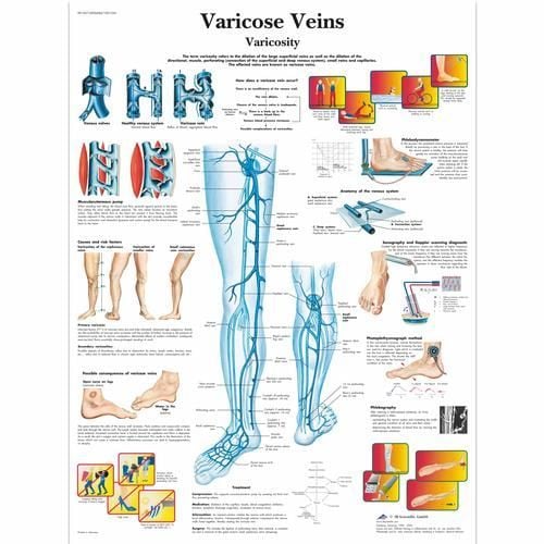 Image 1 of 3B Scientific Varicose Veins Chart