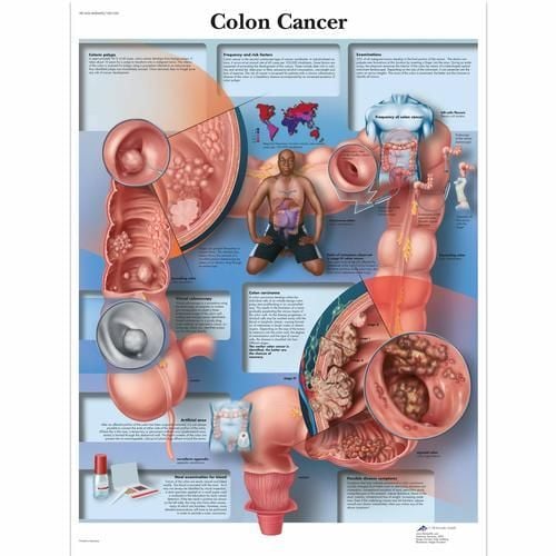 Image 1 of 3B Scientific Colon Cancer Chart